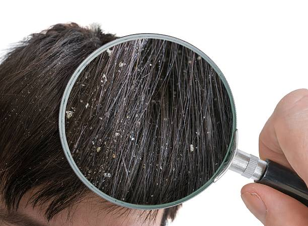 Home Remedies for DandruffHome Remedies for Dandruff